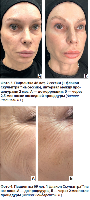 Полимолочная кислота в косметологии фото до и после