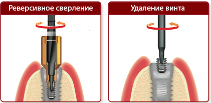NeoBiotech набор для извлечения поврежденных винтов NeoBiotech набор для извлечения поврежденных винтов