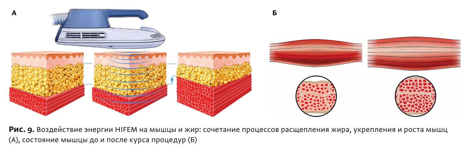 Физиотерапия бтл что это. Смотреть фото Физиотерапия бтл что это. Смотреть картинку Физиотерапия бтл что это. Картинка про Физиотерапия бтл что это. Фото Физиотерапия бтл что это