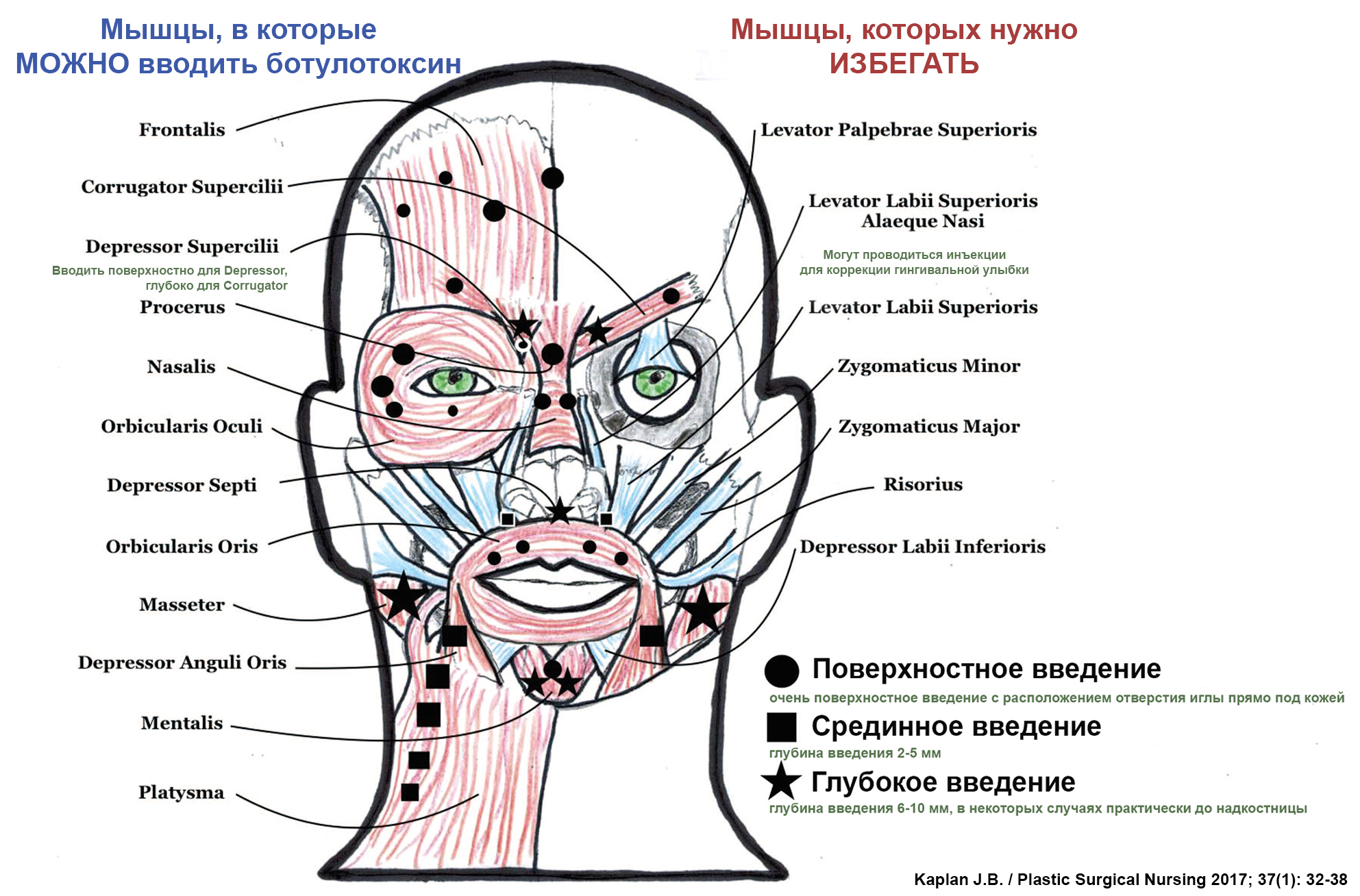 Как колоть ботокс схема