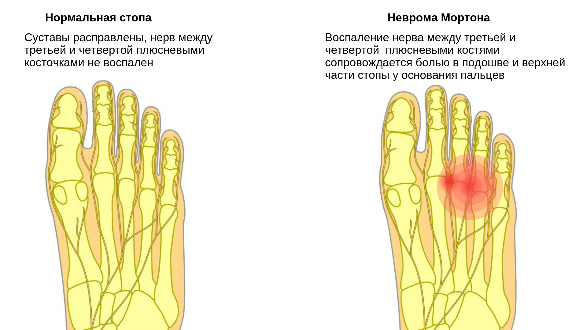 Причины болят пальцы на ногах почему. Боли в плюсневых костях стопы.