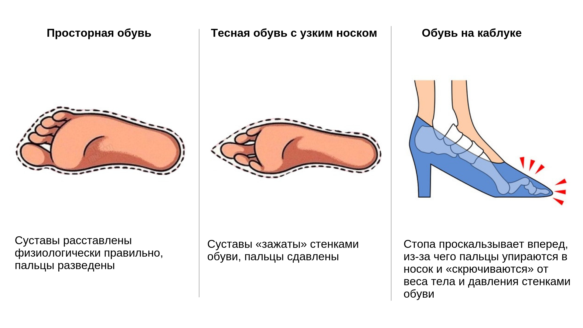 Почему нельзя ногу на ногу. Неправильно подобранная обувь. Тесная обувь. Положение стопы в обуви. Ношение неправильной обуви.