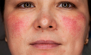Аллергия на лице у взрослых