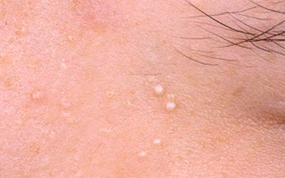 Атопический дерматит. Причины, симптомы и рекомендации по уходу за кожей детей и взрослых