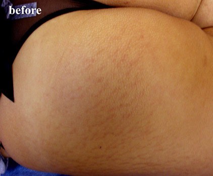 ΠΌΠΎΠΆΠ½ΠΎ Π»ΠΈ ΡΠ±ΡΠ°ΡΡ ΡΠ°ΡΡΡΠΆΠΊΠΈ ΠΌΠ΅Π·ΠΎΡΠΎΠ»Π»Π΅ΡΠΎΠΌ. Π‘ΠΌΠΎΡΡΠ΅ΡΡ ΡΠΎΡΠΎ ΠΌΠΎΠΆΠ½ΠΎ Π»ΠΈ ΡΠ±ΡΠ°ΡΡ ΡΠ°ΡΡΡΠΆΠΊΠΈ ΠΌΠ΅Π·ΠΎΡΠΎΠ»Π»Π΅ΡΠΎΠΌ. Π‘ΠΌΠΎΡΡΠ΅ΡΡ ΠΊΠ°ΡΡΠΈΠ½ΠΊΡ ΠΌΠΎΠΆΠ½ΠΎ Π»ΠΈ ΡΠ±ΡΠ°ΡΡ ΡΠ°ΡΡΡΠΆΠΊΠΈ ΠΌΠ΅Π·ΠΎΡΠΎΠ»Π»Π΅ΡΠΎΠΌ. ΠΠ°ΡΡΠΈΠ½ΠΊΠ° ΠΏΡΠΎ ΠΌΠΎΠΆΠ½ΠΎ Π»ΠΈ ΡΠ±ΡΠ°ΡΡ ΡΠ°ΡΡΡΠΆΠΊΠΈ ΠΌΠ΅Π·ΠΎΡΠΎΠ»Π»Π΅ΡΠΎΠΌ. Π€ΠΎΡΠΎ ΠΌΠΎΠΆΠ½ΠΎ Π»ΠΈ ΡΠ±ΡΠ°ΡΡ ΡΠ°ΡΡΡΠΆΠΊΠΈ ΠΌΠ΅Π·ΠΎΡΠΎΠ»Π»Π΅ΡΠΎΠΌ ΠΌΠΎΠΆΠ½ΠΎ Π»ΠΈ ΡΠ±ΡΠ°ΡΡ ΡΠ°ΡΡΡΠΆΠΊΠΈ ΠΌΠ΅Π·ΠΎΡΠΎΠ»Π»Π΅ΡΠΎΠΌ. Π‘ΠΌΠΎΡΡΠ΅ΡΡ ΡΠΎΡΠΎ ΠΌΠΎΠΆΠ½ΠΎ Π»ΠΈ ΡΠ±ΡΠ°ΡΡ ΡΠ°ΡΡΡΠΆΠΊΠΈ ΠΌΠ΅Π·ΠΎΡΠΎΠ»Π»Π΅ΡΠΎΠΌ. Π‘ΠΌΠΎΡΡΠ΅ΡΡ ΠΊΠ°ΡΡΠΈΠ½ΠΊΡ ΠΌΠΎΠΆΠ½ΠΎ Π»ΠΈ ΡΠ±ΡΠ°ΡΡ ΡΠ°ΡΡΡΠΆΠΊΠΈ ΠΌΠ΅Π·ΠΎΡΠΎΠ»Π»Π΅ΡΠΎΠΌ. ΠΠ°ΡΡΠΈΠ½ΠΊΠ° ΠΏΡΠΎ ΠΌΠΎΠΆΠ½ΠΎ Π»ΠΈ ΡΠ±ΡΠ°ΡΡ ΡΠ°ΡΡΡΠΆΠΊΠΈ ΠΌΠ΅Π·ΠΎΡΠΎΠ»Π»Π΅ΡΠΎΠΌ. Π€ΠΎΡΠΎ ΠΌΠΎΠΆΠ½ΠΎ Π»ΠΈ ΡΠ±ΡΠ°ΡΡ ΡΠ°ΡΡΡΠΆΠΊΠΈ ΠΌΠ΅Π·ΠΎΡΠΎΠ»Π»Π΅ΡΠΎΠΌ