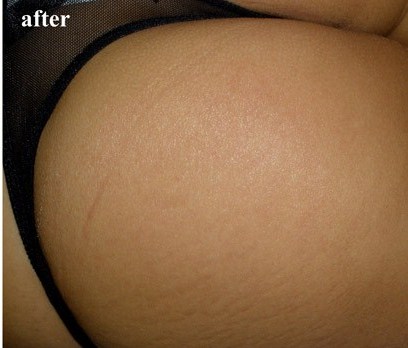 ΠΌΠΎΠΆΠ½ΠΎ Π»ΠΈ ΡΠ±ΡΠ°ΡΡ ΡΠ°ΡΡΡΠΆΠΊΠΈ ΠΌΠ΅Π·ΠΎΡΠΎΠ»Π»Π΅ΡΠΎΠΌ. Π‘ΠΌΠΎΡΡΠ΅ΡΡ ΡΠΎΡΠΎ ΠΌΠΎΠΆΠ½ΠΎ Π»ΠΈ ΡΠ±ΡΠ°ΡΡ ΡΠ°ΡΡΡΠΆΠΊΠΈ ΠΌΠ΅Π·ΠΎΡΠΎΠ»Π»Π΅ΡΠΎΠΌ. Π‘ΠΌΠΎΡΡΠ΅ΡΡ ΠΊΠ°ΡΡΠΈΠ½ΠΊΡ ΠΌΠΎΠΆΠ½ΠΎ Π»ΠΈ ΡΠ±ΡΠ°ΡΡ ΡΠ°ΡΡΡΠΆΠΊΠΈ ΠΌΠ΅Π·ΠΎΡΠΎΠ»Π»Π΅ΡΠΎΠΌ. ΠΠ°ΡΡΠΈΠ½ΠΊΠ° ΠΏΡΠΎ ΠΌΠΎΠΆΠ½ΠΎ Π»ΠΈ ΡΠ±ΡΠ°ΡΡ ΡΠ°ΡΡΡΠΆΠΊΠΈ ΠΌΠ΅Π·ΠΎΡΠΎΠ»Π»Π΅ΡΠΎΠΌ. Π€ΠΎΡΠΎ ΠΌΠΎΠΆΠ½ΠΎ Π»ΠΈ ΡΠ±ΡΠ°ΡΡ ΡΠ°ΡΡΡΠΆΠΊΠΈ ΠΌΠ΅Π·ΠΎΡΠΎΠ»Π»Π΅ΡΠΎΠΌ ΠΌΠΎΠΆΠ½ΠΎ Π»ΠΈ ΡΠ±ΡΠ°ΡΡ ΡΠ°ΡΡΡΠΆΠΊΠΈ ΠΌΠ΅Π·ΠΎΡΠΎΠ»Π»Π΅ΡΠΎΠΌ. Π‘ΠΌΠΎΡΡΠ΅ΡΡ ΡΠΎΡΠΎ ΠΌΠΎΠΆΠ½ΠΎ Π»ΠΈ ΡΠ±ΡΠ°ΡΡ ΡΠ°ΡΡΡΠΆΠΊΠΈ ΠΌΠ΅Π·ΠΎΡΠΎΠ»Π»Π΅ΡΠΎΠΌ. Π‘ΠΌΠΎΡΡΠ΅ΡΡ ΠΊΠ°ΡΡΠΈΠ½ΠΊΡ ΠΌΠΎΠΆΠ½ΠΎ Π»ΠΈ ΡΠ±ΡΠ°ΡΡ ΡΠ°ΡΡΡΠΆΠΊΠΈ ΠΌΠ΅Π·ΠΎΡΠΎΠ»Π»Π΅ΡΠΎΠΌ. ΠΠ°ΡΡΠΈΠ½ΠΊΠ° ΠΏΡΠΎ ΠΌΠΎΠΆΠ½ΠΎ Π»ΠΈ ΡΠ±ΡΠ°ΡΡ ΡΠ°ΡΡΡΠΆΠΊΠΈ ΠΌΠ΅Π·ΠΎΡΠΎΠ»Π»Π΅ΡΠΎΠΌ. Π€ΠΎΡΠΎ ΠΌΠΎΠΆΠ½ΠΎ Π»ΠΈ ΡΠ±ΡΠ°ΡΡ ΡΠ°ΡΡΡΠΆΠΊΠΈ ΠΌΠ΅Π·ΠΎΡΠΎΠ»Π»Π΅ΡΠΎΠΌ