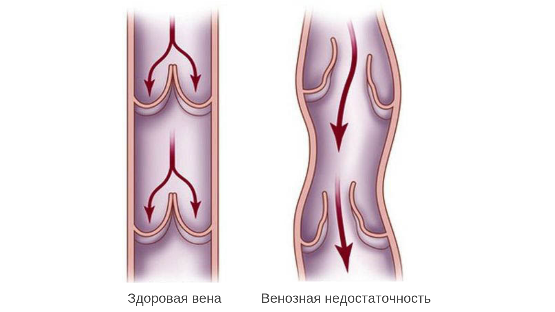 Тромбоз кровотечение. Варикозное расширение вен ХВН 1 степени. Варикозное расширение вен нижних конечностей ХВН. Варикозно расширенные вены.