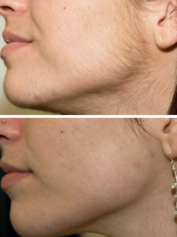 volosy na lice do i posle raboty fotoepilyatora можно ли использовать фотоэпилятор на лице