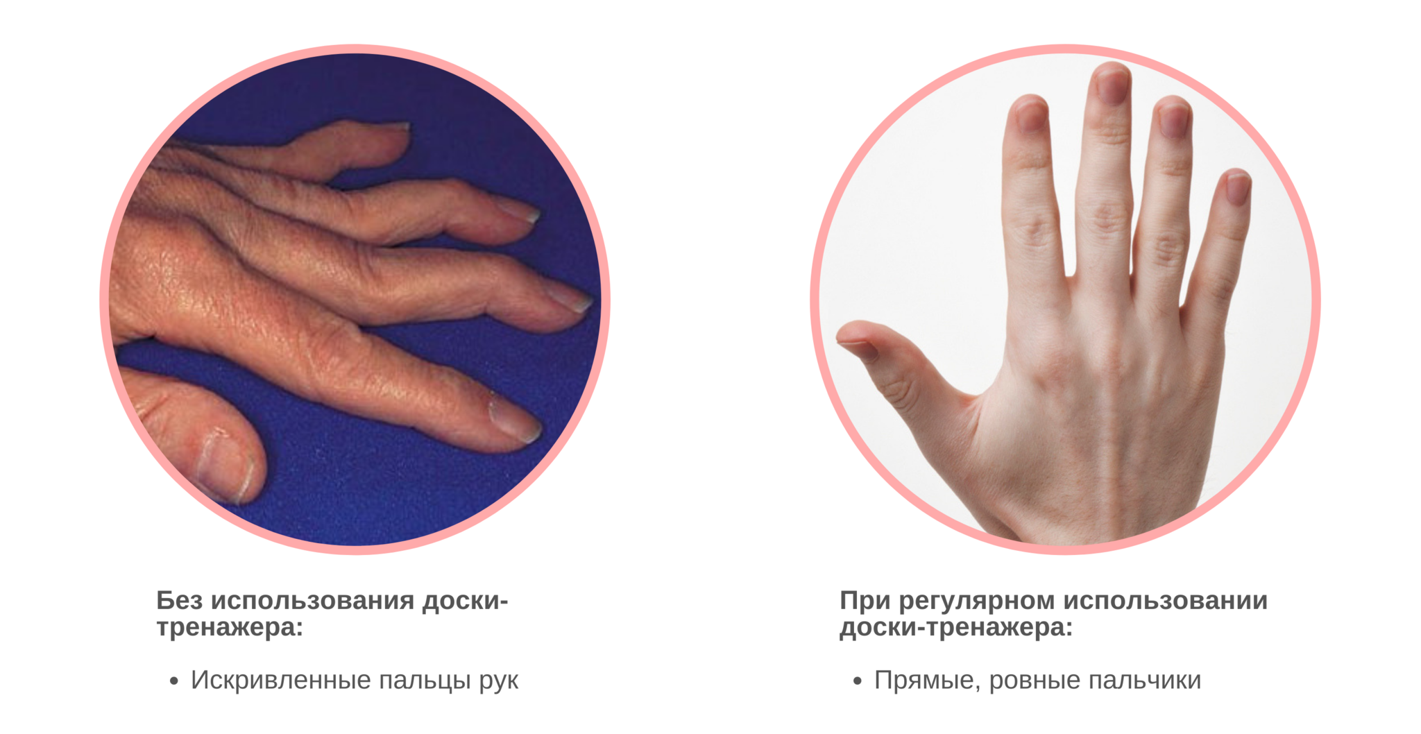 Возможно ли пальцем. Выпрямление пальца на руке. Тренажер для выпрямления пальцев. Как можно выпрямить пальцы на руках. Штука для выпрямления пальца на руке.